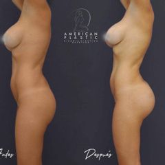 Gluteoplastia - American Plastic