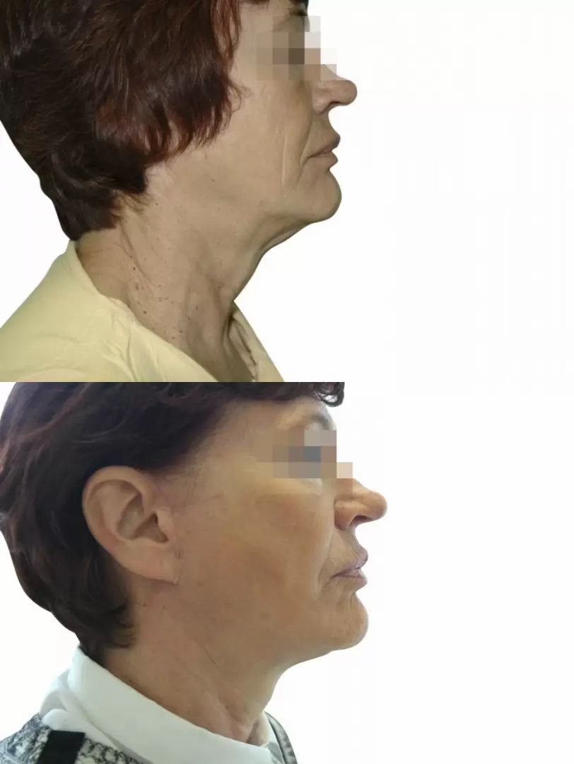 odstranění podbradku faceliftky. Fotky před a po odstranění druhé brady