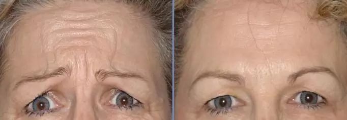 fotky před a po vyhlazení vrásek botoxem