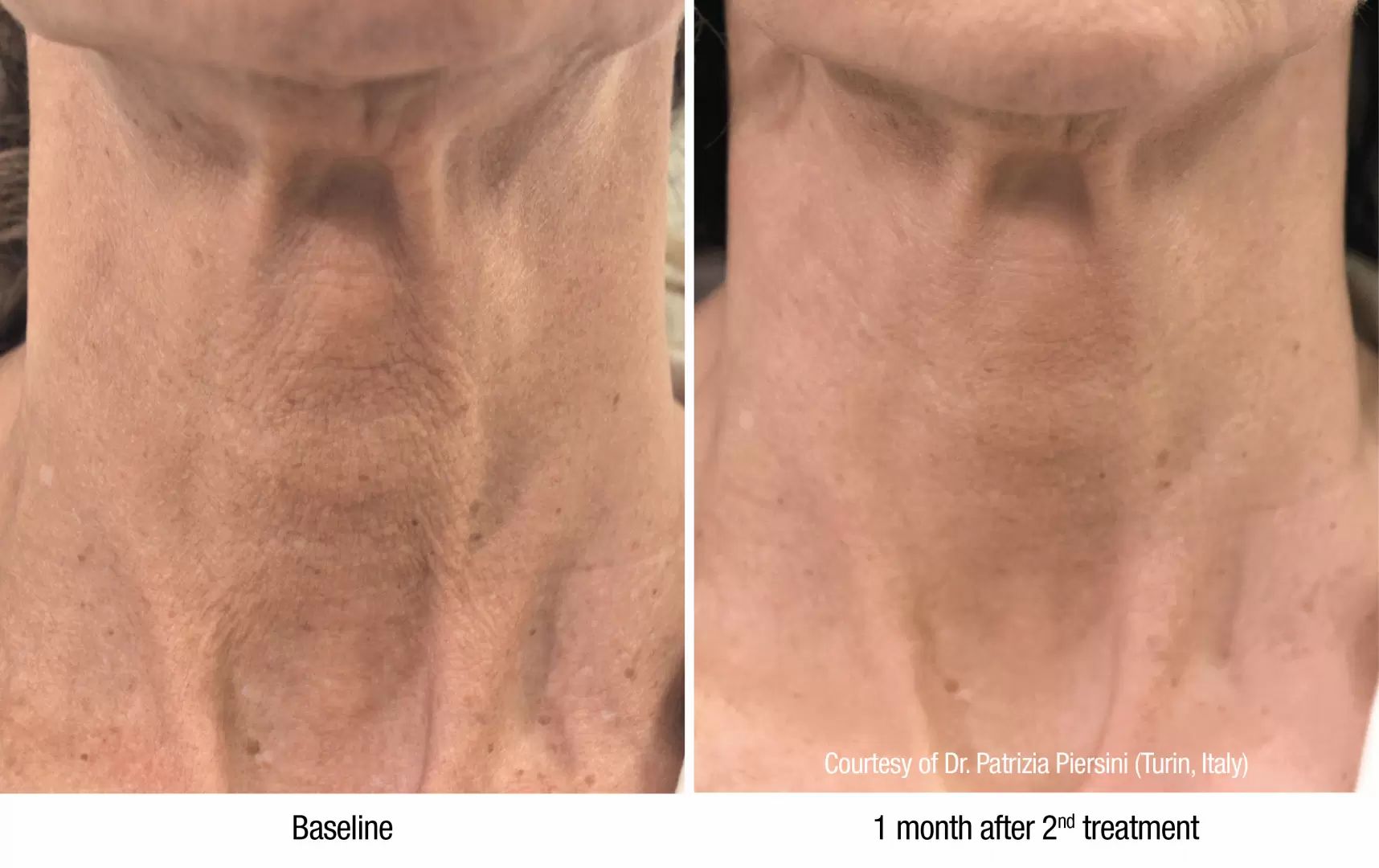 fotky před a po aplikac Profhilo, omlazení a hydratace krku