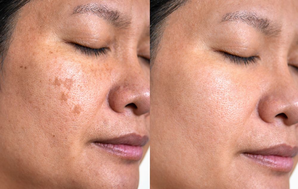 melasma