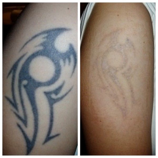odstranění tetování 4