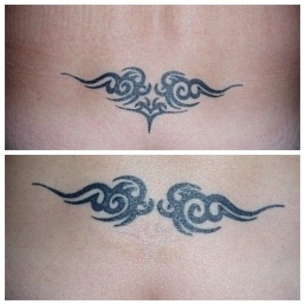 odstranění tetování