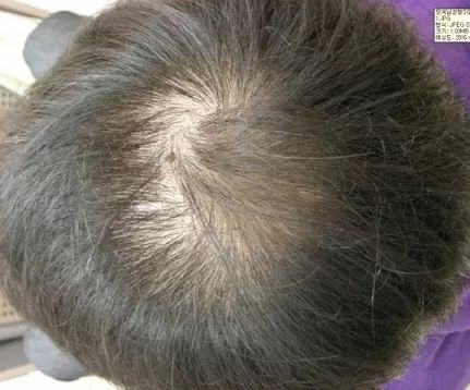 vlasova mezoterapie2