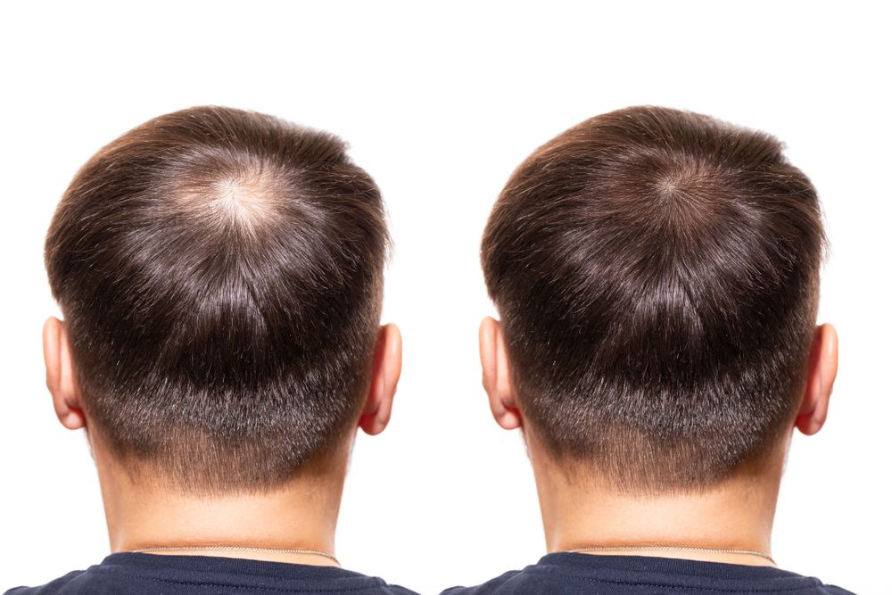 před a po transplantaci vlasů