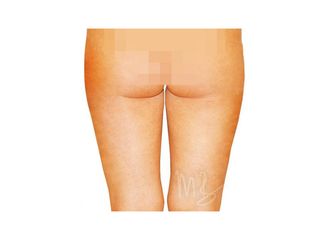 Fettabsaugung - Doc. MUDr. M. Boháč