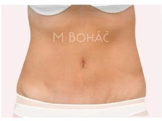 Bauchdeckenstraffung - Doc. MUDr. M. Boháč