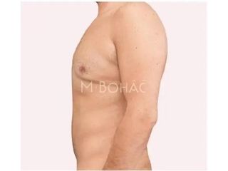 Bauchdeckenstraffung - Doc. MUDr. M. Boháč