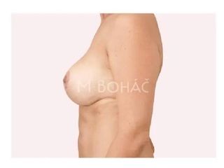 Bruststraffung - Doc. MUDr. M. Boháč