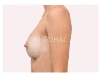 Bruststraffung mit Implantat - Doc. MUDr. M. Boháč