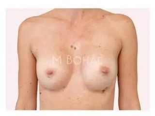 Bruststraffung mit Implantat - Doc. MUDr. M. Boháč