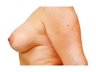Bruststraffung mit Implantat - Doc. MUDr. M. Boháč