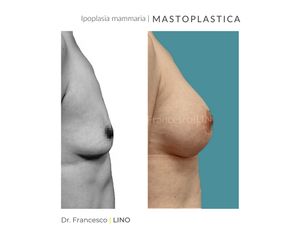 Mastoplastica additiva - Dott. Francesco Lino