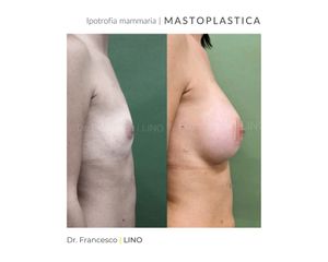 Mastoplastica additiva - Dott. Francesco Lino