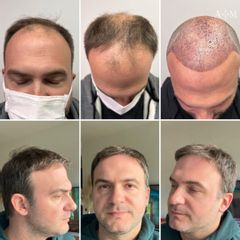Trapianto di Capelli - AraMedica