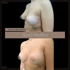 Mastoplastica Additiva - AraMedica