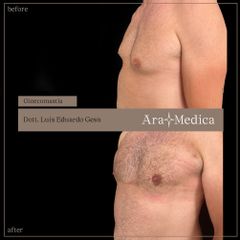 Ginecomastia - AraMedica