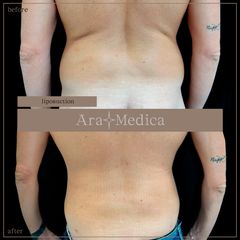 Liposuzione - AraMedica