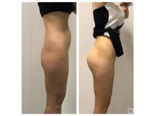 Gluteoplastica - Dr. Gioia Mario