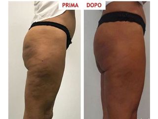 Cellulite - Dr. Gioia Mario