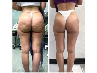 Cellulite - Dr. Gioia Mario