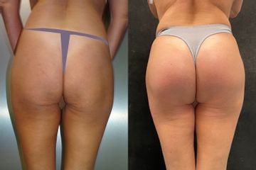 Gluteoplastica - Dr. Gioia Mario