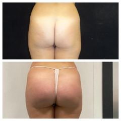 Gluteoplastica - Dr. Gioia Mario