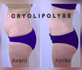 Criolipolisi - Dr. Gioia Mario