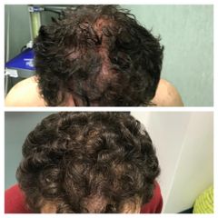 Prp per alopecia - Dr. Gioia Mario