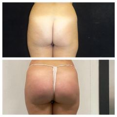 Gluteoplastica - Dr. Gioia Mario