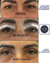 Dott. Manuel De Giovanni Blefaroplastica superiore dopo 7 giorni
