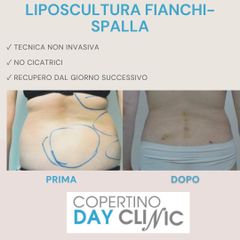 Liposuzione - Dott. Luigi Nestola