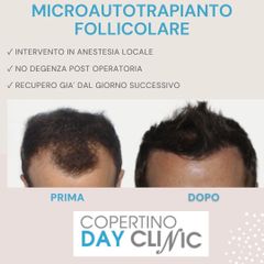 Trapianto capelli - Dott. Luigi Nestola