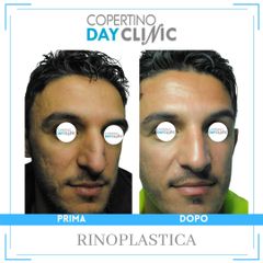 Rinoplastica - Chirurgia Estetica Nestola - Dott. Luigi Nestola