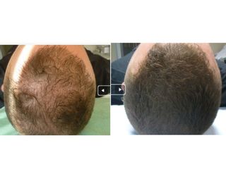 Tricopigmentazione capelli prima e dopo