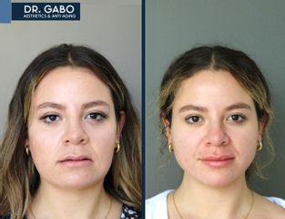 Aumento de labios - Artsthetik Dr. Gabo