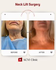 Lifting twarzy - KCM Clinic Chirurgia Plastyczna i Bariatria