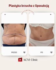 Plastyka brzucha - KCM Clinic Chirurgia Plastyczna i Bariatria