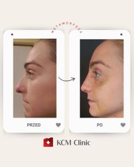 Korekta nosa - KCM Clinic Chirurgia Plastyczna i Bariatria