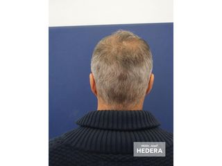 Transplantácia vlasov - MUDr. Jozef Hedera
