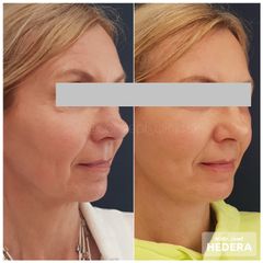 mudr. jozef hedera_facelift_concept clinic (1)