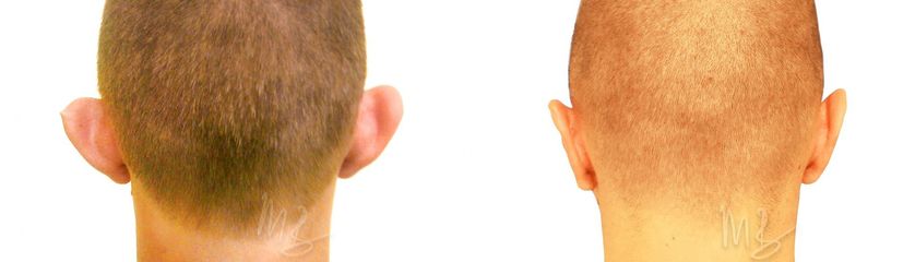 Operácia uší (Otoplastika)