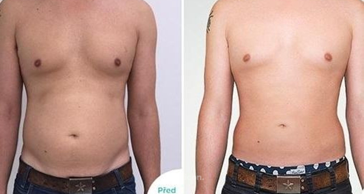 Abdominoplastika nebo klasická liposukce? Co je pro vaše břicho lepší?