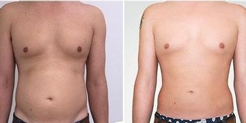 Abdominoplastika nebo klasická liposukce? Co je pro vaše břicho lepší? Abdominoplastika nebo klasická liposukce? Co je pro vaše břicho lepší?