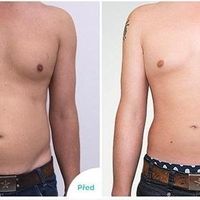 Abdominoplastika nebo klasická liposukce? Co je pro vaše břicho lepší?