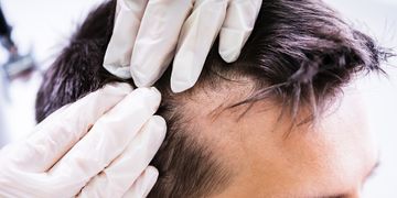 Biofibre hair - implantace umělých vlasů