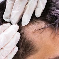 Biofibre hair - implantace umělých vlasů