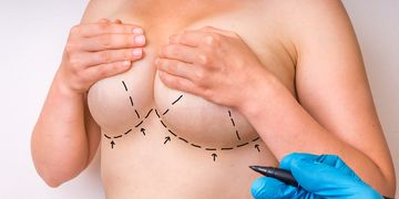 Co vás, nás, může potkat po augmentaci silikonovými implantáty Co vás, nás, může potkat po augmentaci silikonovými implantáty