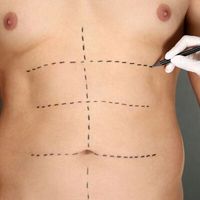 David zhubl 75 kg: „Abdominoplastika je pro mě druhá šance na normální život" David zhubl 75 kg: „Abdominoplastika je pro mě druhá šance na normální život"