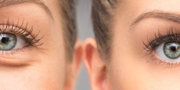 Kdy a komu pomůže operace očních víček (blefaroplastika)?